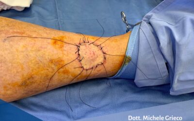 Auto-trapianto cutaneo per cancro